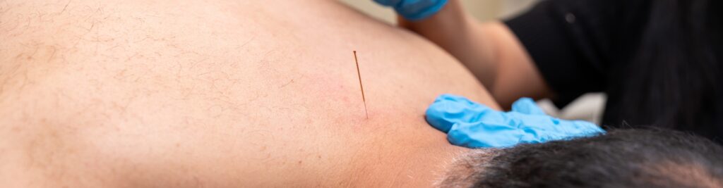 acupuncture-MeadowLife-Physiotherapy-and-Active-Rehab-Centre-Pitt-Meadows-BC