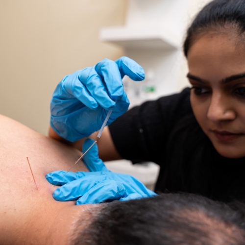 acupuncture-MeadowLife-Physiotherapy-and-Active-Rehab-Centre-Pitt-Meadows-BC-500x500