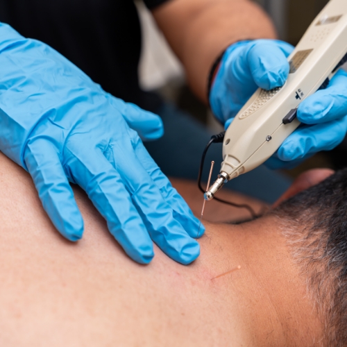 dry-needling-MeadowLife-Physiotherapy-and-Active-Rehab-Centre-Pitt-Meadows-BC-500x500